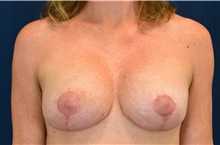 Breast Implant Revision After Photo by Michael Frederick, MD; Fort Lauderdale, FL - Case 39904