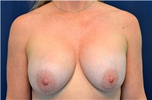 Breast Implant Revision Before Photo by Michael Frederick, MD; Fort Lauderdale, FL - Case 39904