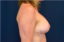 Breast Implant Revision After Photo by Michael Frederick, MD; Fort Lauderdale, FL - Case 39904
