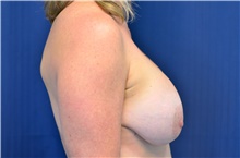 Breast Implant Revision Before Photo by Michael Frederick, MD; Fort Lauderdale, FL - Case 39904