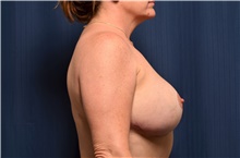 Breast Implant Revision After Photo by Michael Frederick, MD; Fort Lauderdale, FL - Case 39905
