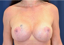 Breast Implant Revision After Photo by Michael Frederick, MD; Fort Lauderdale, FL - Case 39908