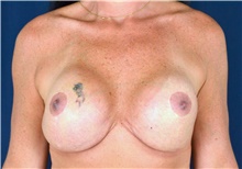 Breast Implant Revision Before Photo by Michael Frederick, MD; Fort Lauderdale, FL - Case 39908