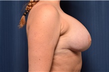 Breast Implant Revision After Photo by Michael Frederick, MD; Fort Lauderdale, FL - Case 39914