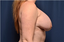 Breast Implant Revision Before Photo by Michael Frederick, MD; Fort Lauderdale, FL - Case 39914