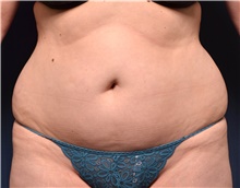 Liposuction Before Photo by Michael Frederick, MD; Fort Lauderdale, FL - Case 39934