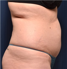 Liposuction Before Photo by Michael Frederick, MD; Fort Lauderdale, FL - Case 39934