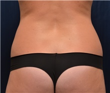 Liposuction Before Photo by Michael Frederick, MD; Fort Lauderdale, FL - Case 39947