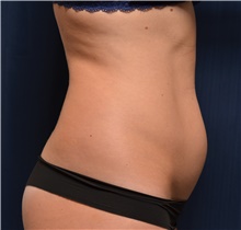 Liposuction Before Photo by Michael Frederick, MD; Fort Lauderdale, FL - Case 39947