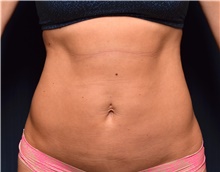 Liposuction After Photo by Michael Frederick, MD; Fort Lauderdale, FL - Case 39947