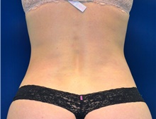 Liposuction After Photo by Michael Frederick, MD; Fort Lauderdale, FL - Case 39949