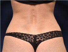 Liposuction Before Photo by Michael Frederick, MD; Fort Lauderdale, FL - Case 39949