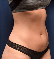 Liposuction Before Photo by Michael Frederick, MD; Fort Lauderdale, FL - Case 39949