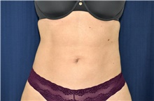 Liposuction After Photo by Michael Frederick, MD; Fort Lauderdale, FL - Case 39952