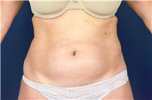 Liposuction Before Photo by Michael Frederick, MD; Fort Lauderdale, FL - Case 39952