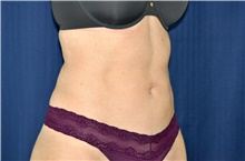 Liposuction After Photo by Michael Frederick, MD; Fort Lauderdale, FL - Case 39952
