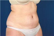 Liposuction Before Photo by Michael Frederick, MD; Fort Lauderdale, FL - Case 39952
