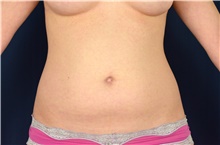 Liposuction Before Photo by Michael Frederick, MD; Fort Lauderdale, FL - Case 39958