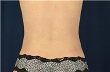 Liposuction After Photo by Michael Frederick, MD; Fort Lauderdale, FL - Case 39958