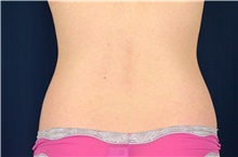 Liposuction Before Photo by Michael Frederick, MD; Fort Lauderdale, FL - Case 39958