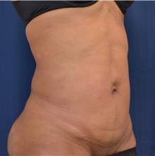 Tummy Tuck After Photo by Michael Frederick, MD; Fort Lauderdale, FL - Case 39965