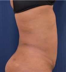 Tummy Tuck After Photo by Michael Frederick, MD; Fort Lauderdale, FL - Case 39965
