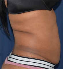 Tummy Tuck Before Photo by Michael Frederick, MD; Fort Lauderdale, FL - Case 39965