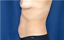 Liposuction Before Photo by Michael Frederick, MD; Fort Lauderdale, FL - Case 39967