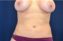 Liposuction After Photo by Michael Frederick, MD; Fort Lauderdale, FL - Case 39967