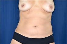 Liposuction Before Photo by Michael Frederick, MD; Fort Lauderdale, FL - Case 39967