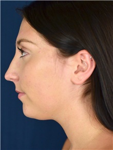Liposuction Before Photo by Michael Frederick, MD; Fort Lauderdale, FL - Case 39968