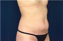 Liposuction Before Photo by Michael Frederick, MD; Fort Lauderdale, FL - Case 39970