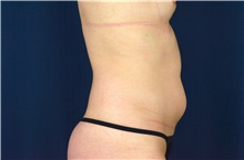 Liposuction Before Photo by Michael Frederick, MD; Fort Lauderdale, FL - Case 39970