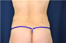 Liposuction After Photo by Michael Frederick, MD; Fort Lauderdale, FL - Case 39970