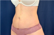 Liposuction After Photo by Michael Frederick, MD; Fort Lauderdale, FL - Case 39974