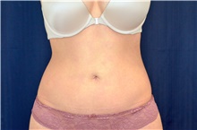 Liposuction After Photo by Michael Frederick, MD; Fort Lauderdale, FL - Case 39974