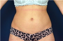 Liposuction Before Photo by Michael Frederick, MD; Fort Lauderdale, FL - Case 39974