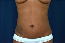 Liposuction After Photo by Michael Frederick, MD; Fort Lauderdale, FL - Case 39977