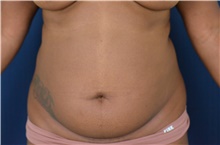 Liposuction Before Photo by Michael Frederick, MD; Fort Lauderdale, FL - Case 39977