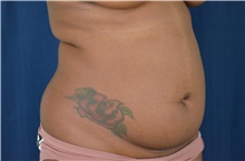 Liposuction Before Photo by Michael Frederick, MD; Fort Lauderdale, FL - Case 39977