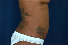 Liposuction After Photo by Michael Frederick, MD; Fort Lauderdale, FL - Case 39977