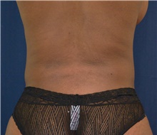 Liposuction After Photo by Michael Frederick, MD; Fort Lauderdale, FL - Case 39978
