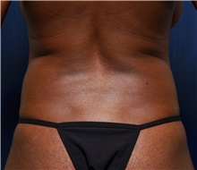 Liposuction Before Photo by Michael Frederick, MD; Fort Lauderdale, FL - Case 39978