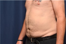 Liposuction After Photo by Michael Frederick, MD; Fort Lauderdale, FL - Case 39979