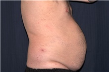 Liposuction Before Photo by Michael Frederick, MD; Fort Lauderdale, FL - Case 39979