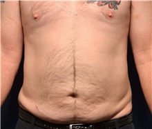 Liposuction After Photo by Michael Frederick, MD; Fort Lauderdale, FL - Case 39979