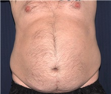 Liposuction Before Photo by Michael Frederick, MD; Fort Lauderdale, FL - Case 39979