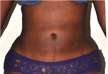 Liposuction After Photo by Michael Frederick, MD; Fort Lauderdale, FL - Case 39982