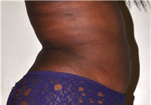 Liposuction After Photo by Michael Frederick, MD; Fort Lauderdale, FL - Case 39982