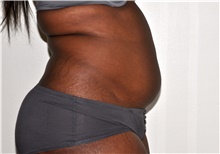 Liposuction Before Photo by Michael Frederick, MD; Fort Lauderdale, FL - Case 39982